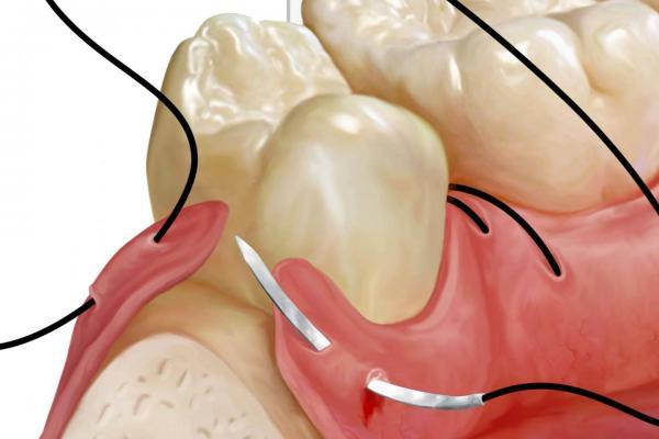 dental-sütür-malzemeleri-suture-ağız-ve-diş-sağlığı-dikiş-ameliyat-ipliği-surgery-çene-cerrahisi